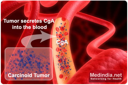 Carcinoid Tumors - Infographic