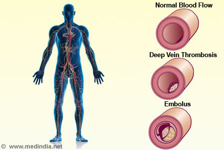 Deep Vein Thrombosis - Infographic