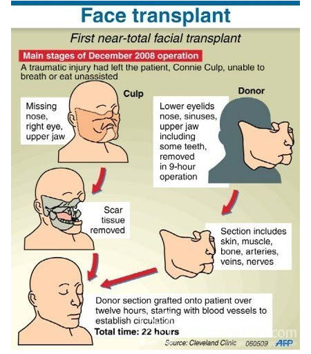 Face Transplant - Infographic