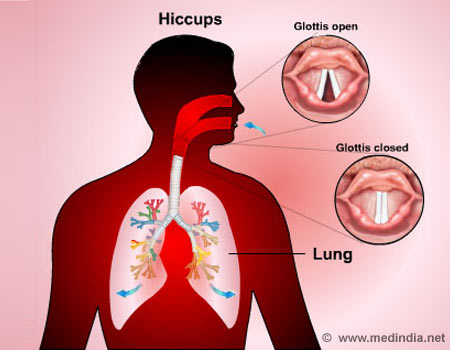 Hiccups - Infographic