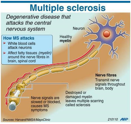 Multiple Sclerosis - New Drug - Infographic