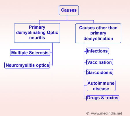 Optic Neuritis - Causes - Infographic