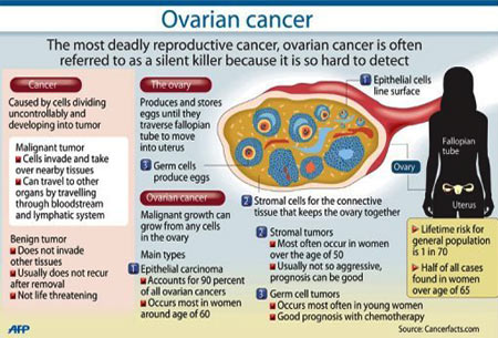 Ovarian Cancer - Infographic