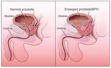 Prostate Gland Enlargement - Infographic