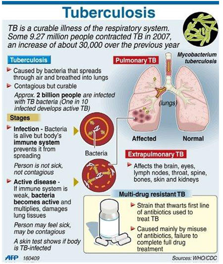 Tuberculosis - Test Kit - Infographic