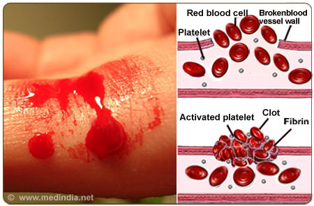 von Willebrand Disease - Infographic