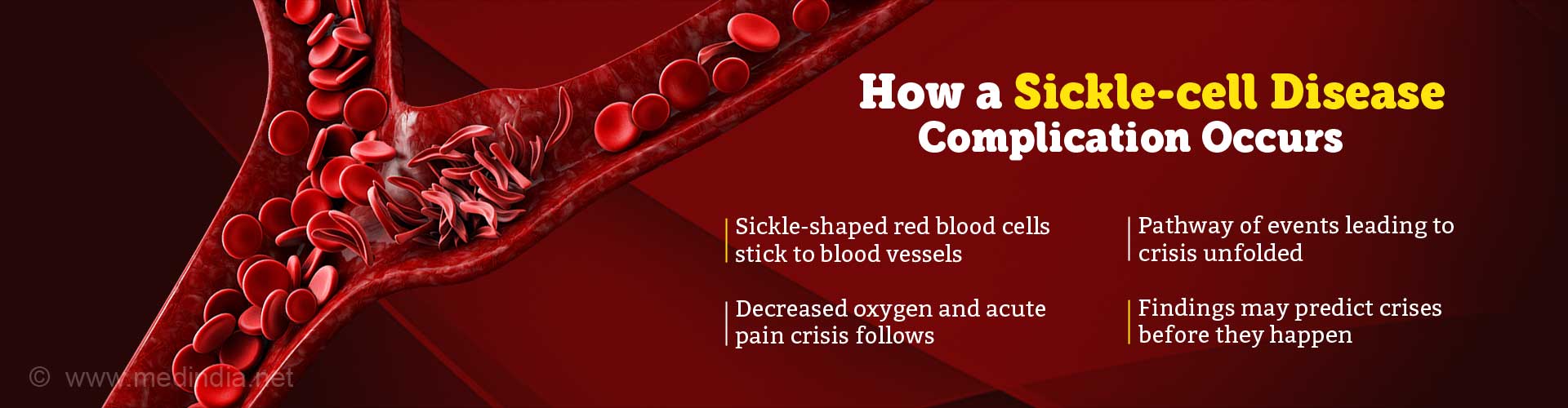 Sickle Cell Crisis