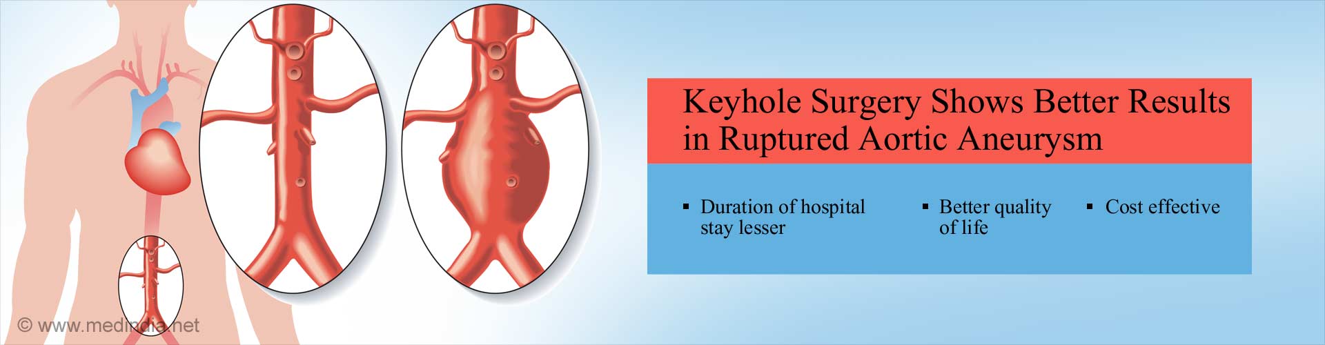 Keyhole Surgery Shows Better Outcomes For Ruptured Aneurysm