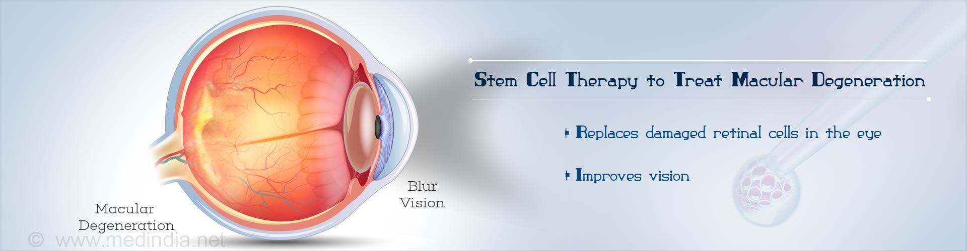 Stem Cell Therapy to Treat Dry Macular Degeneration