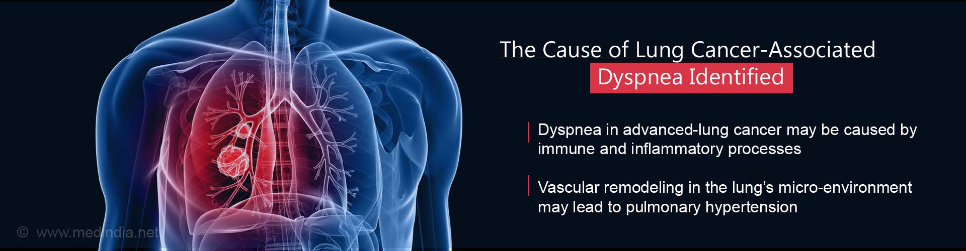 The Cause of Lung Cancer-Associated Dyspnea Identified