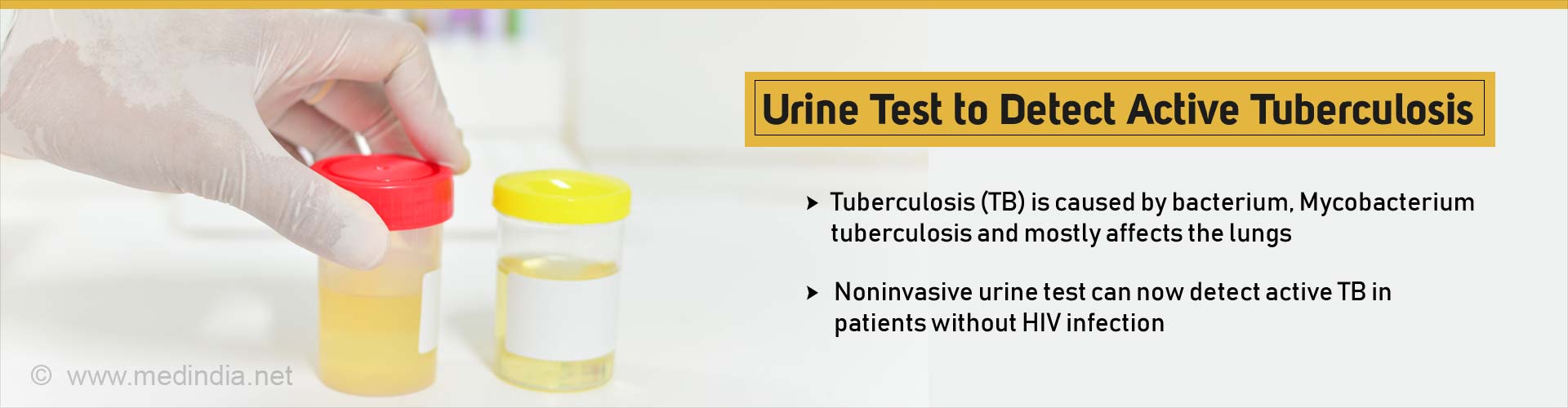 Tb test and hiv