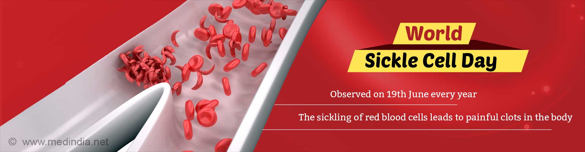 World Sickle Cell Day