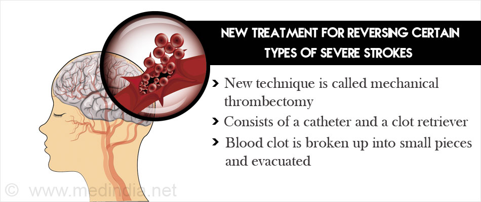 Mechanical Thrombectomy Treatment For Stroke Effective In Bringing ...