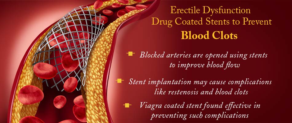 Viagra Coated Stent Reduces Blood Clots Prevents Narrowing of