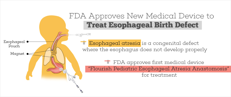 FDA Authorizes First Medical Device For Esophageal Birth Defect In Babies