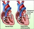 Doctors Reveal Genomics of People With Hypertrophic Cardiomyopathy