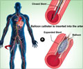 Dual Antiplatelet Therapy Following Coronary Stent Implantation ...