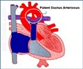 Surgery for Patent Foramen Ovale may not Prevent Stroke