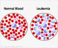 High-risk Pediatric Leukemia and Greater Risk of Relapse Associated ...