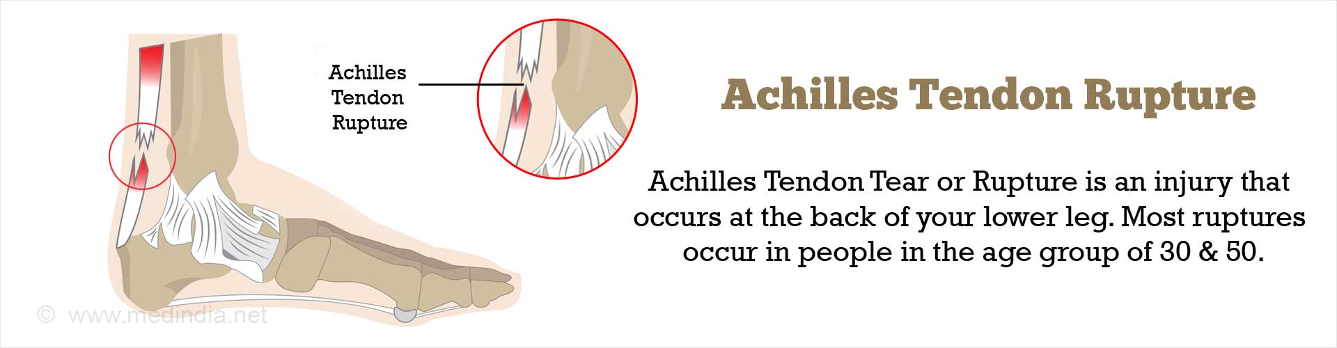 achilles-tendon-rupture-or-tear-symptoms-causes-diagnosis-treatment