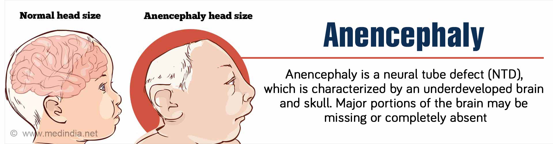 Anencephaly Diagram   Anencephaly Birth Defect 