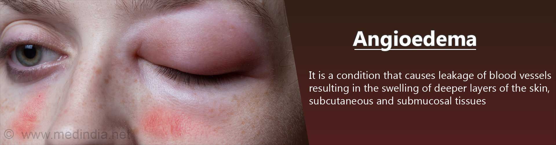 Angioedema Causes Symptoms Diagnosis And Treatment 