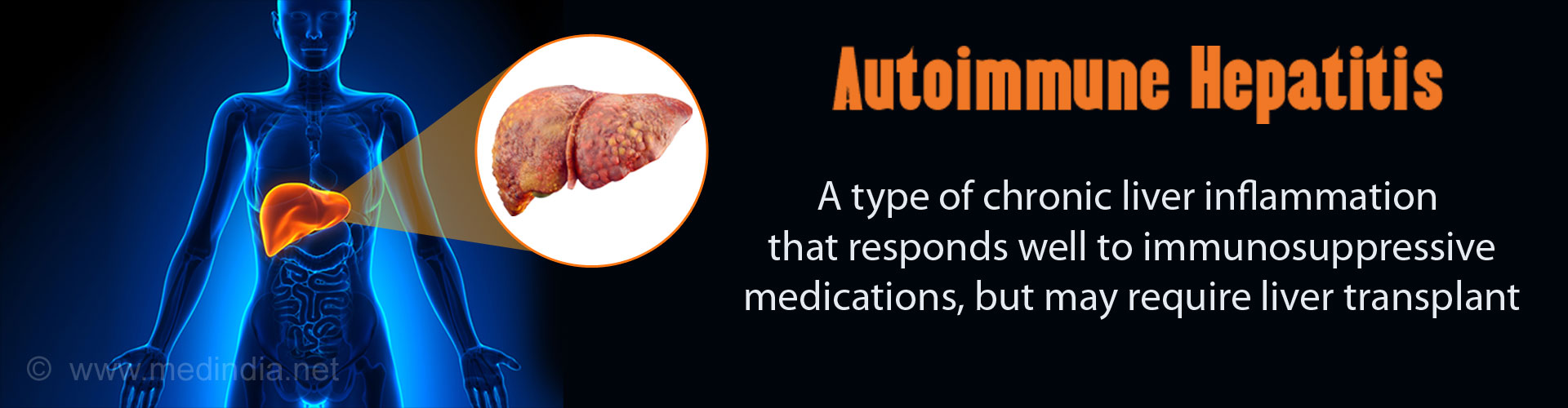 autoimmune-hepatitis-causes-types-symptoms-complications