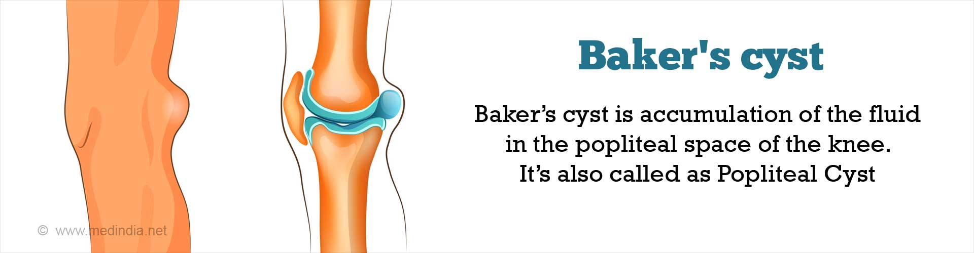 Baker's Cyst - Causes, Symptoms, Diagnosis, Treatment