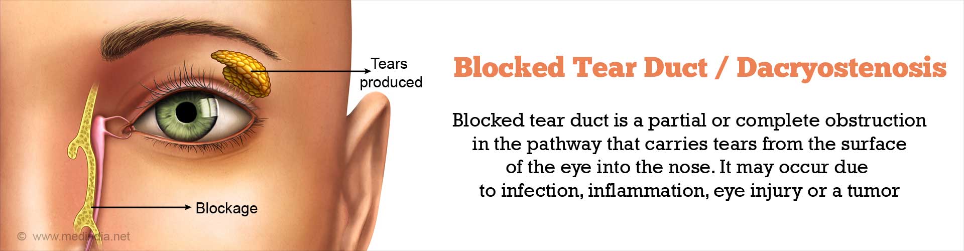 Blocked Tear Duct Causes Symptoms Diagnosis Treatment Faqs 