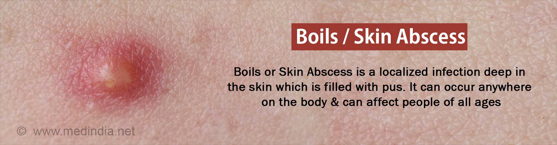 Boils Skin Abscess Causes Symptoms Diagnosis Treatment 7591