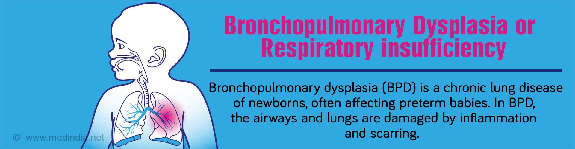 Bronchopulmonary Dysplasia | Respiratory Insufficiency - Causes ...