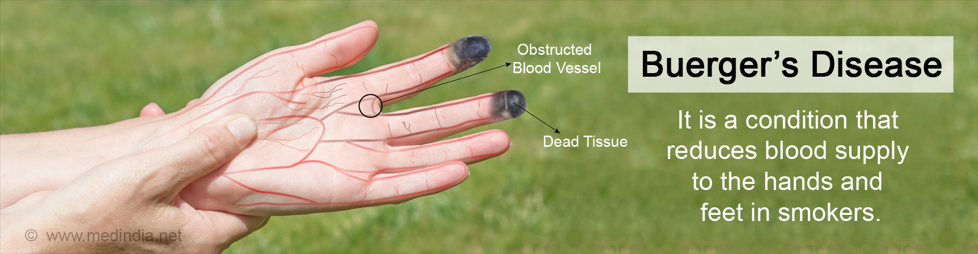 Buerger's Disease - Causes Symptoms Diagnosis & Treatment