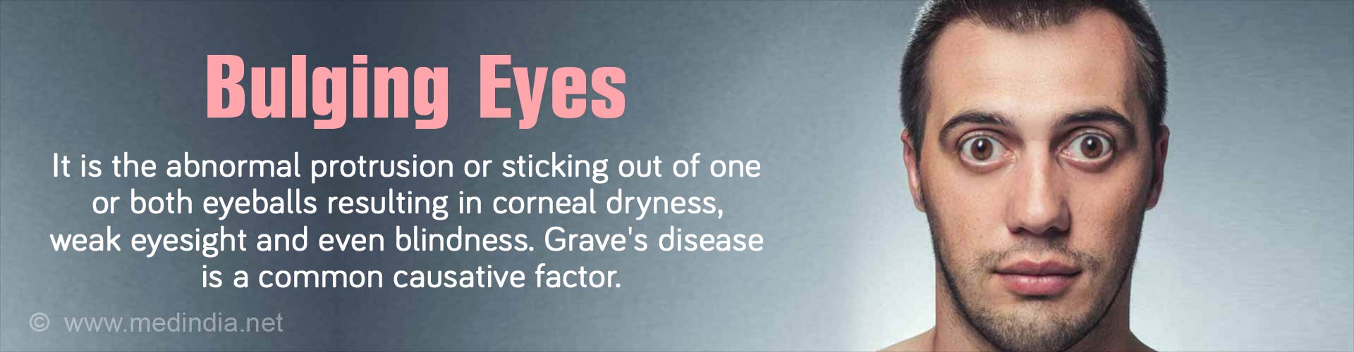 bulging-eyes-eye-proptosis-exophthalmos-causes-symptoms