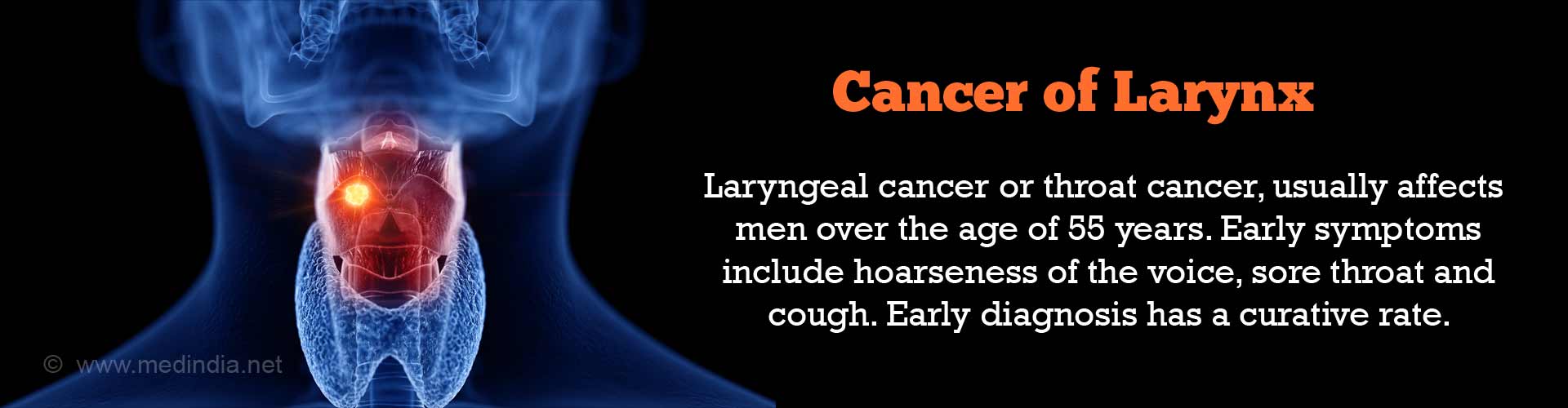 Larynx Cancer Definition Causes Risk Factors Symptoms 6086