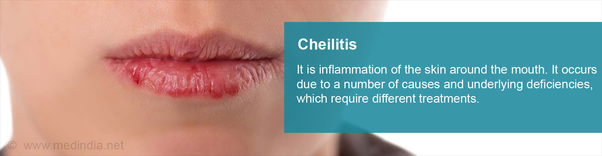 Cheilitis - Causes, Symptoms, Diagnosis & Treatment