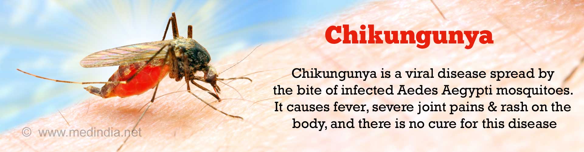 Chikungunya Causes Symptoms Diagnosis Treatment Faqs