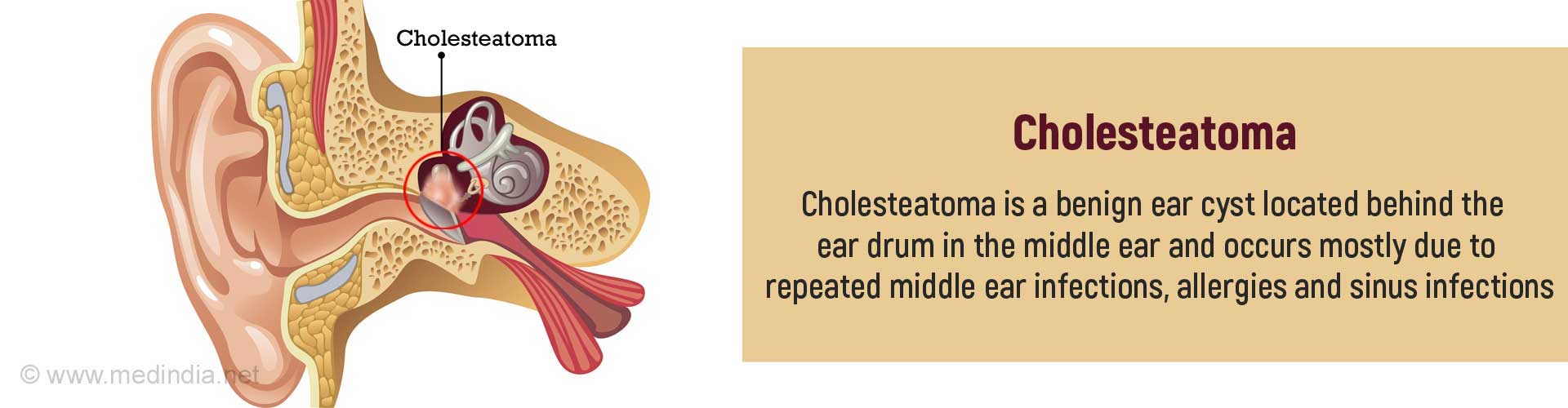 cholesteatoma-cyst-in-middle-ear-benign-ear-cyst