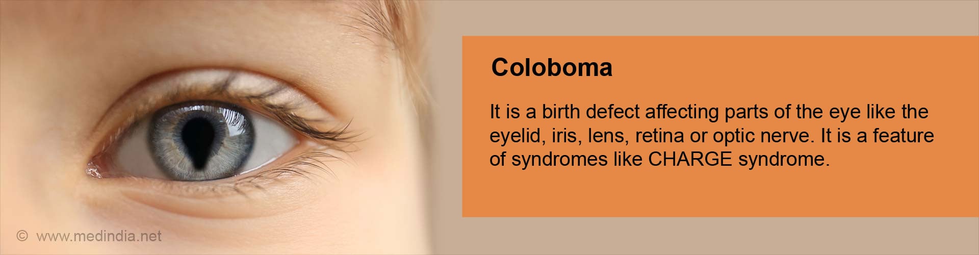 coloboma-causes-symptoms-diagnosis-treatment-prevention