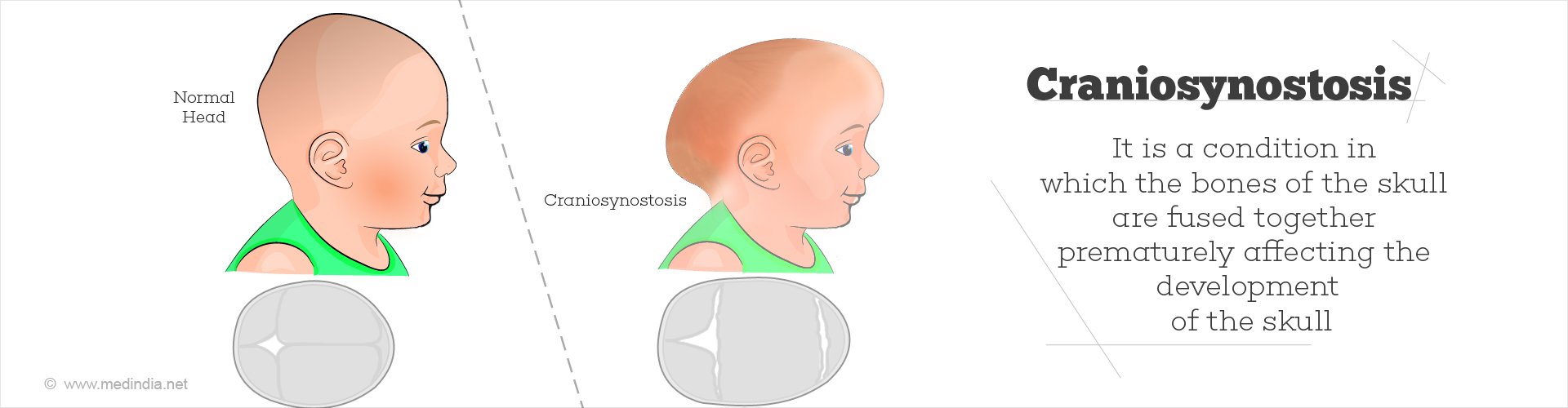 Craniosynostosis Types Causes Symptoms Diagnosis Treatment And Prevention 