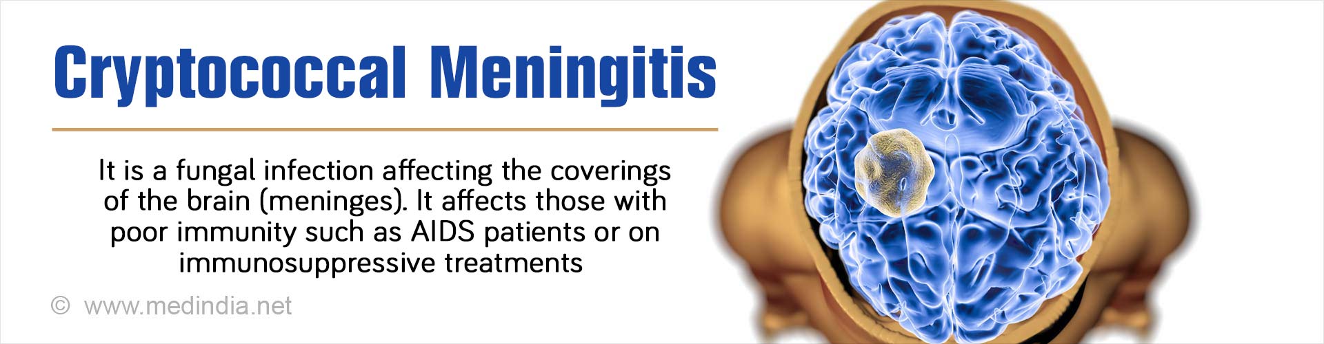 Cryptococcal Meningitis - Causes, Risk Factors, Symptoms, Diagnosis ...