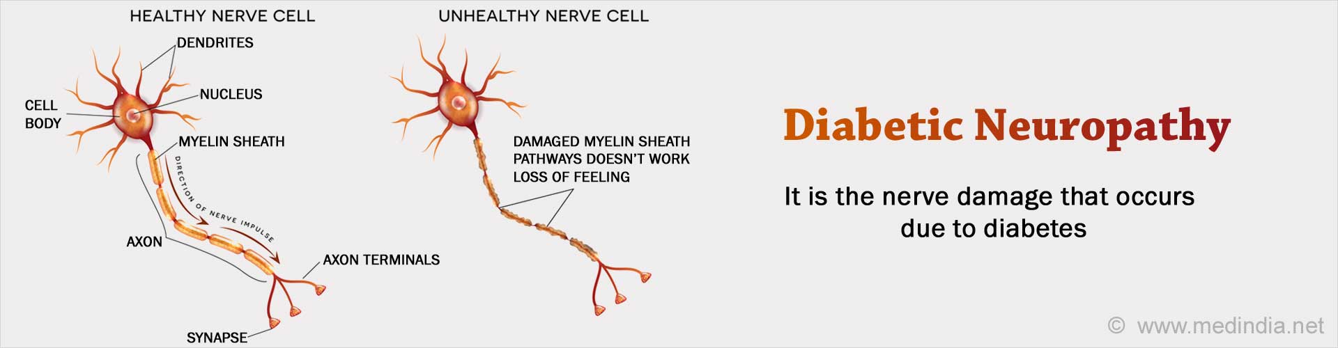 diabetic-neuropathy-types-causes-symptoms-diagnosis-complication