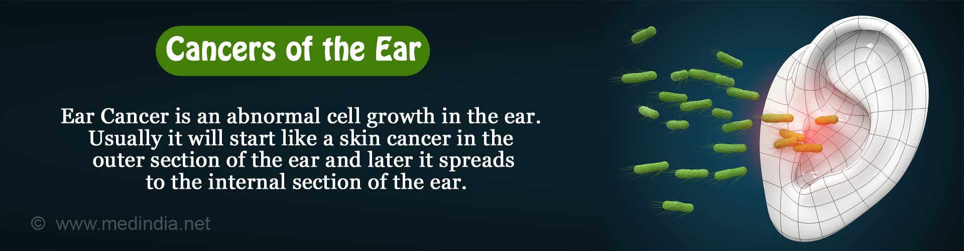 Cancers of the Ear / Ear Cancers Causes, Symptoms, Diagnosis, Treatment