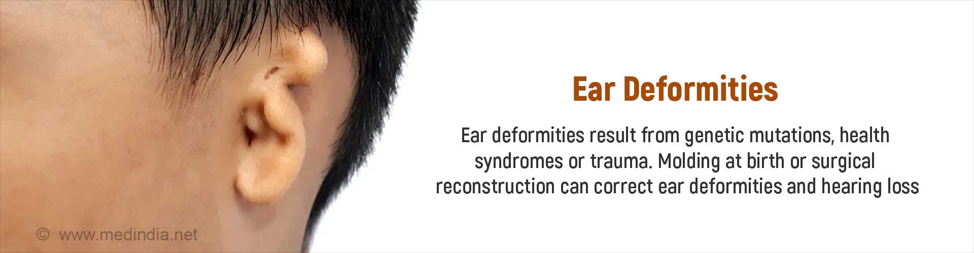 ear-deformities