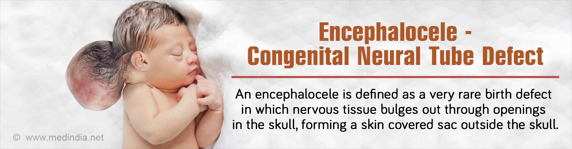 encephalocele-congenital-neural-tube-defect-causes-symptoms