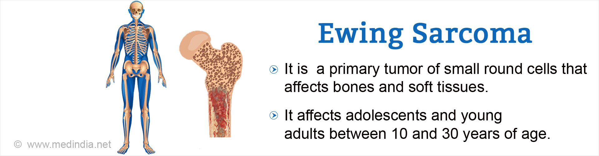 ewing-sarcoma-causes-symptoms-diagnosis-prognosis-treatment