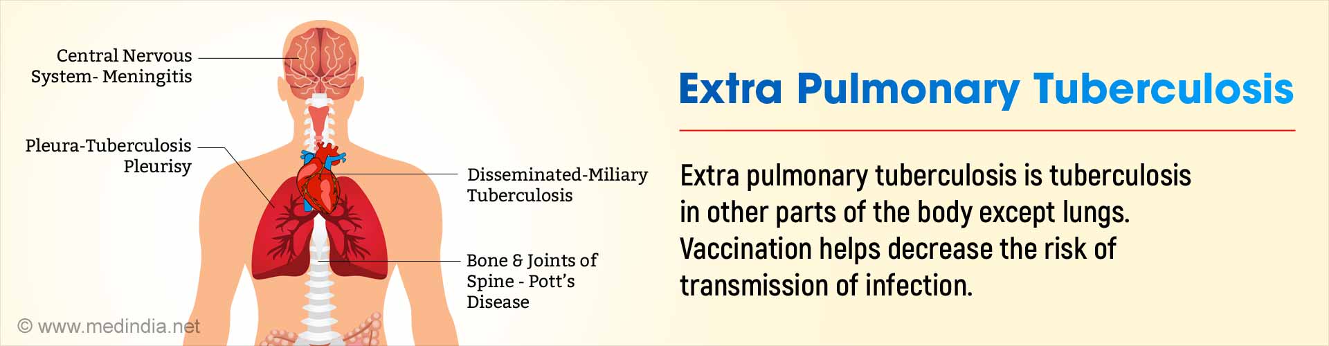 Complications Of Pulmonary Tuberculosis