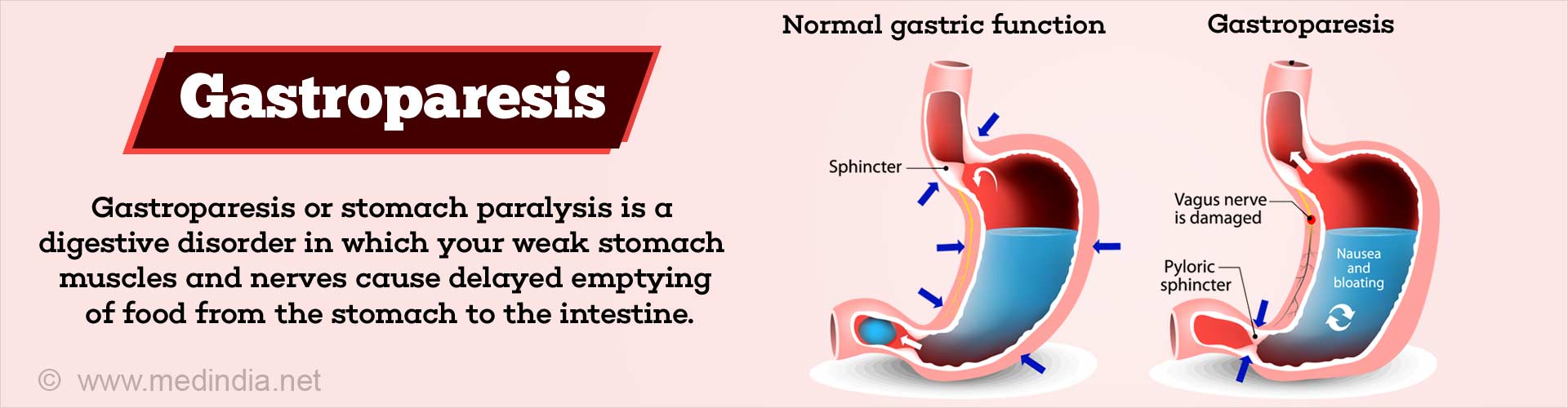 Gastroparesis Stomach Paralysis