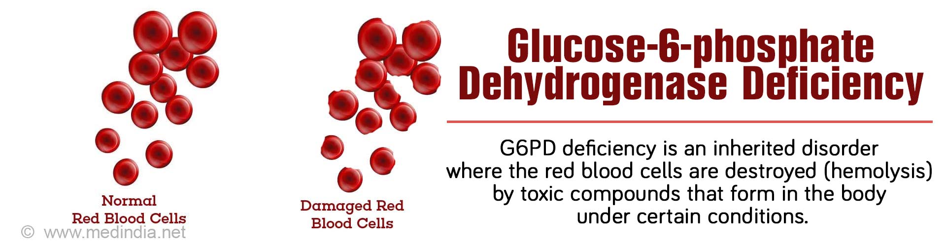 Glucose-6-phosphate Dehydrogenase Deficiency