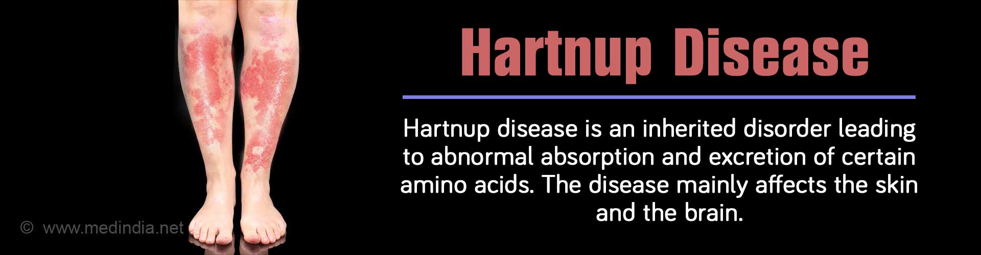 Hartnup Disease - Causes, Symptoms, Diagnosis, Treatment and Prevention