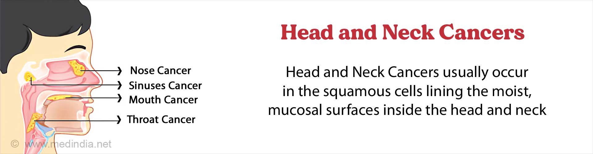 What Are The Different Types Of Head And Neck Cancer